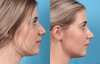 Young female patient Rhinoplasty before and after - right side.