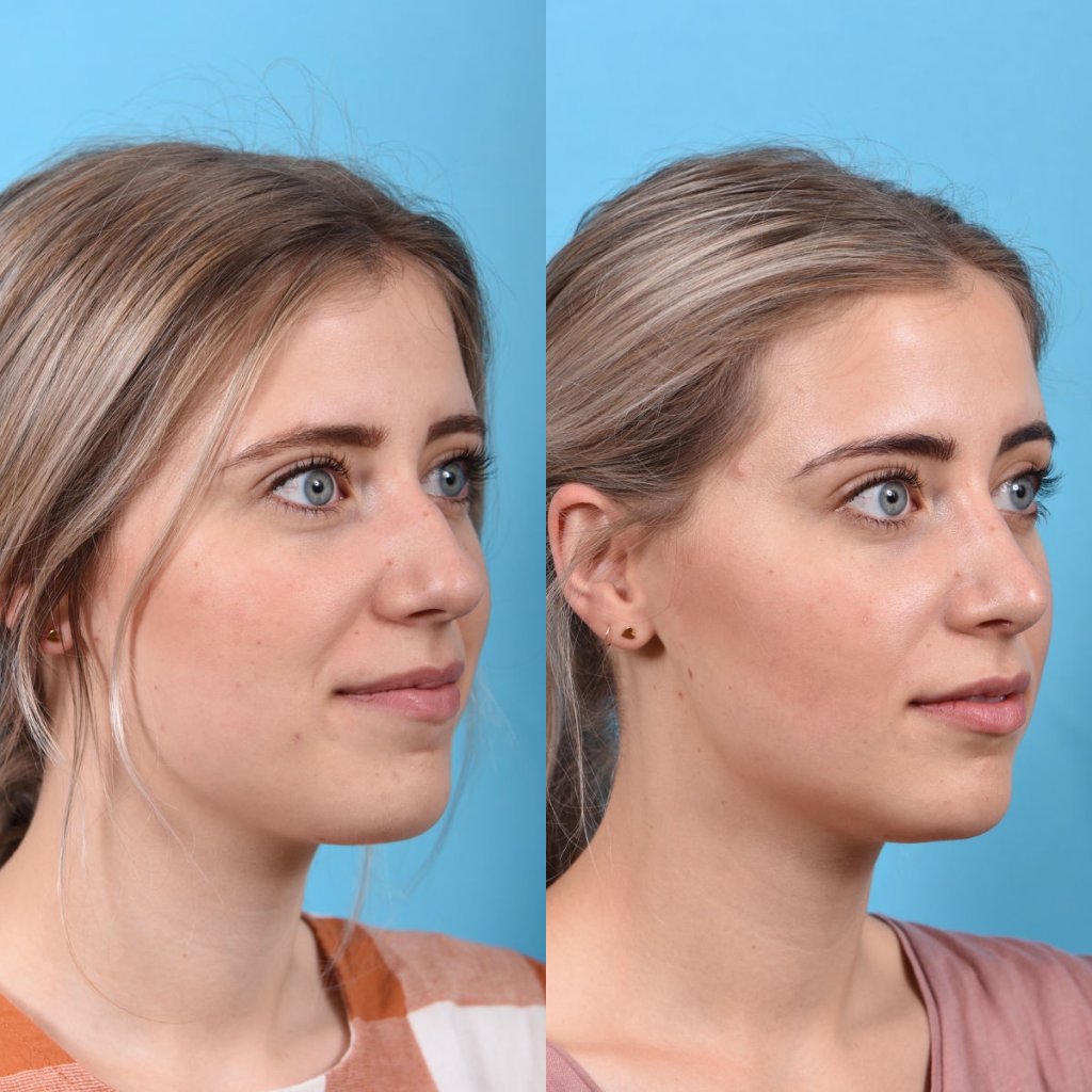 Young female patient Rhinoplasty before and after - right side.