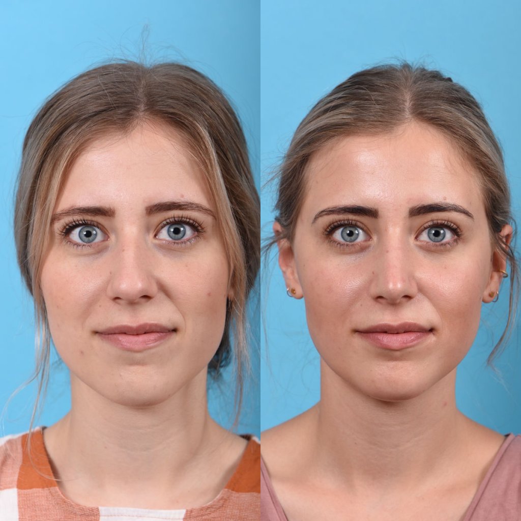 Young female patient Rhinoplasty before and after - front.