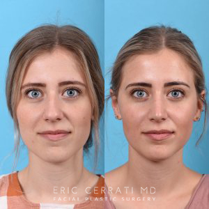 Young female patient Rhinoplasty before and after - front.