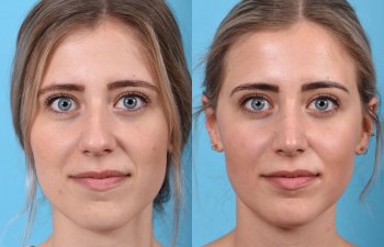 Young female patient Rhinoplasty before and after - front.