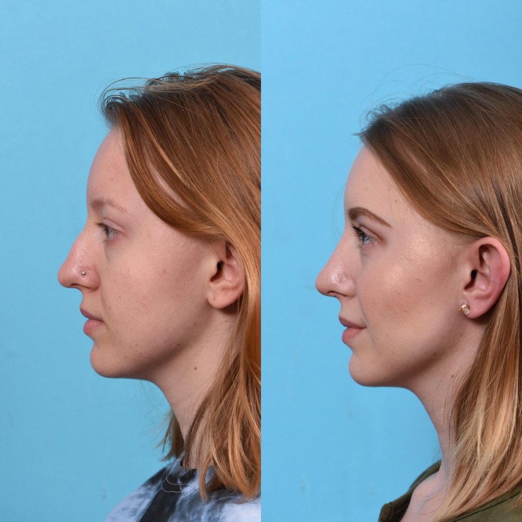 nose before and after