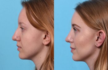 nose before and after