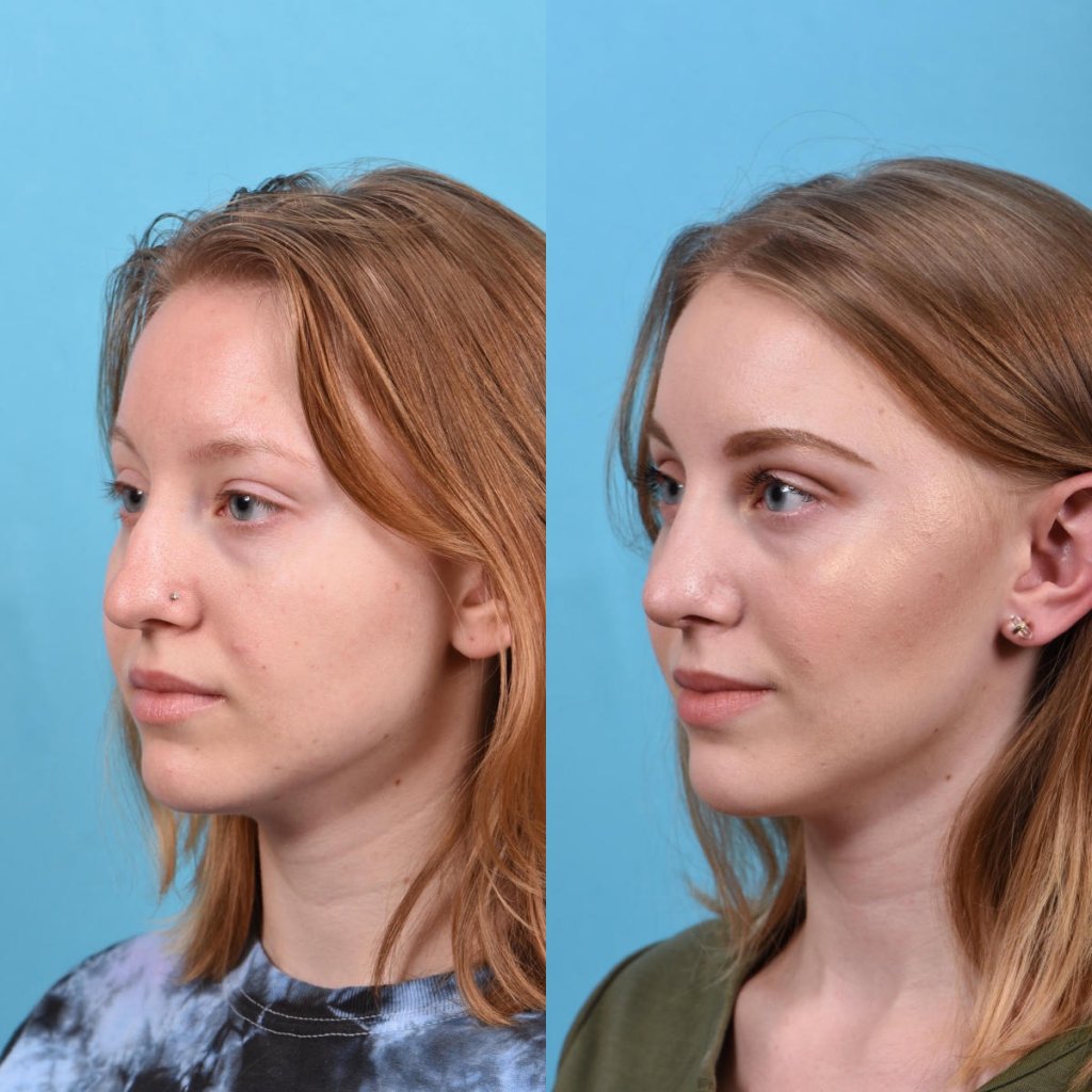 nose before and after