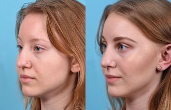 nose before and after