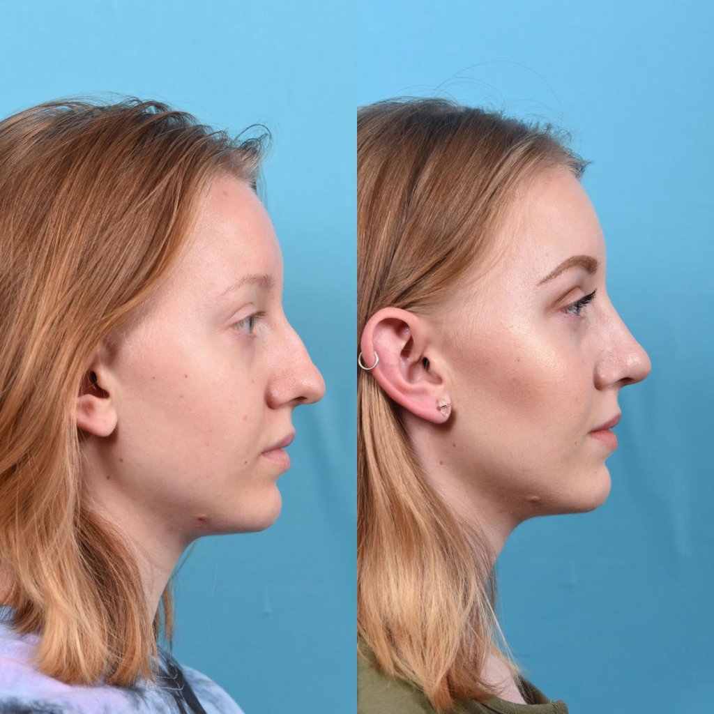 nose before and after