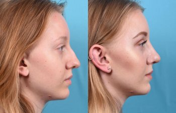 nose before and after
