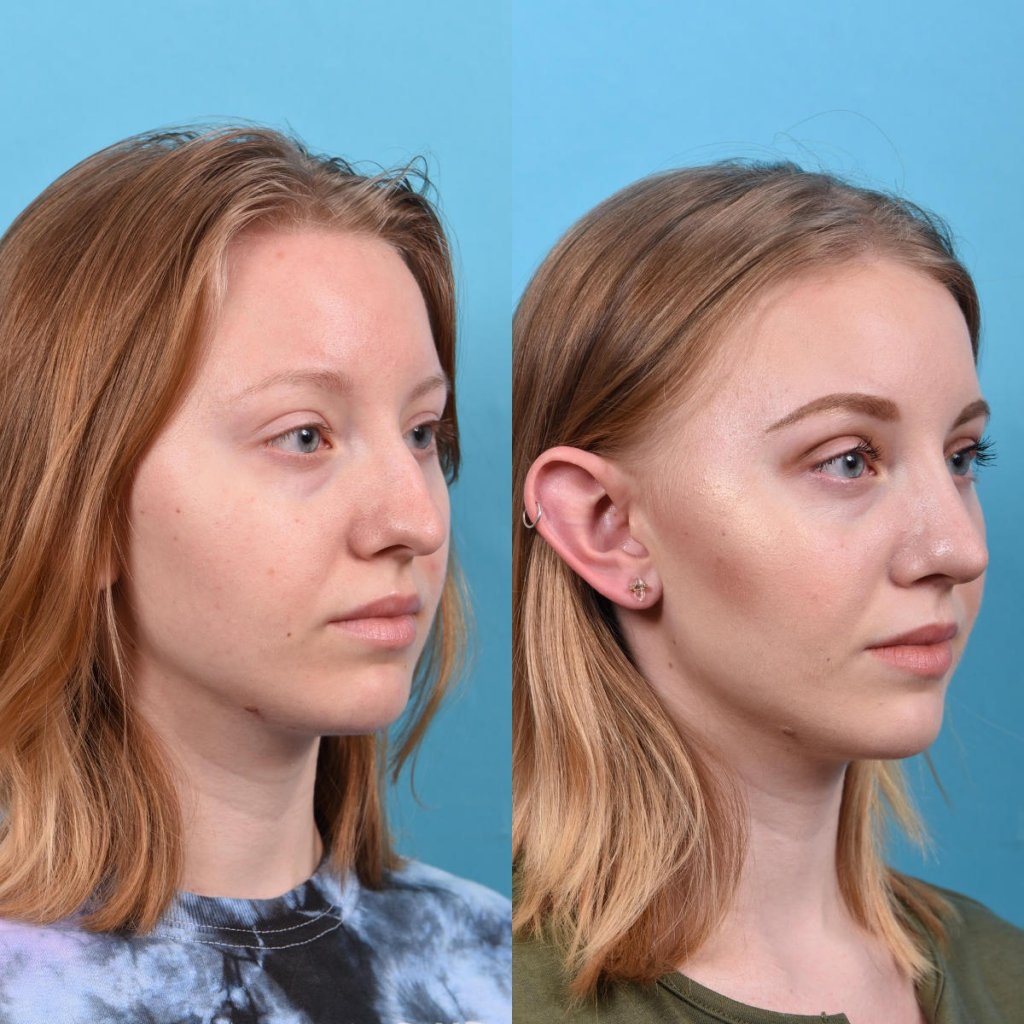 nose before and after