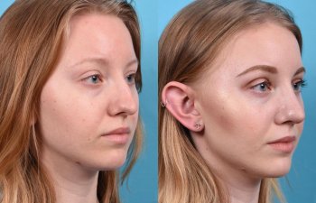 nose before and after