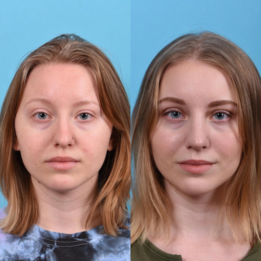 nose before and after