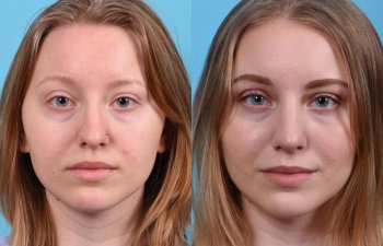 nose before and after