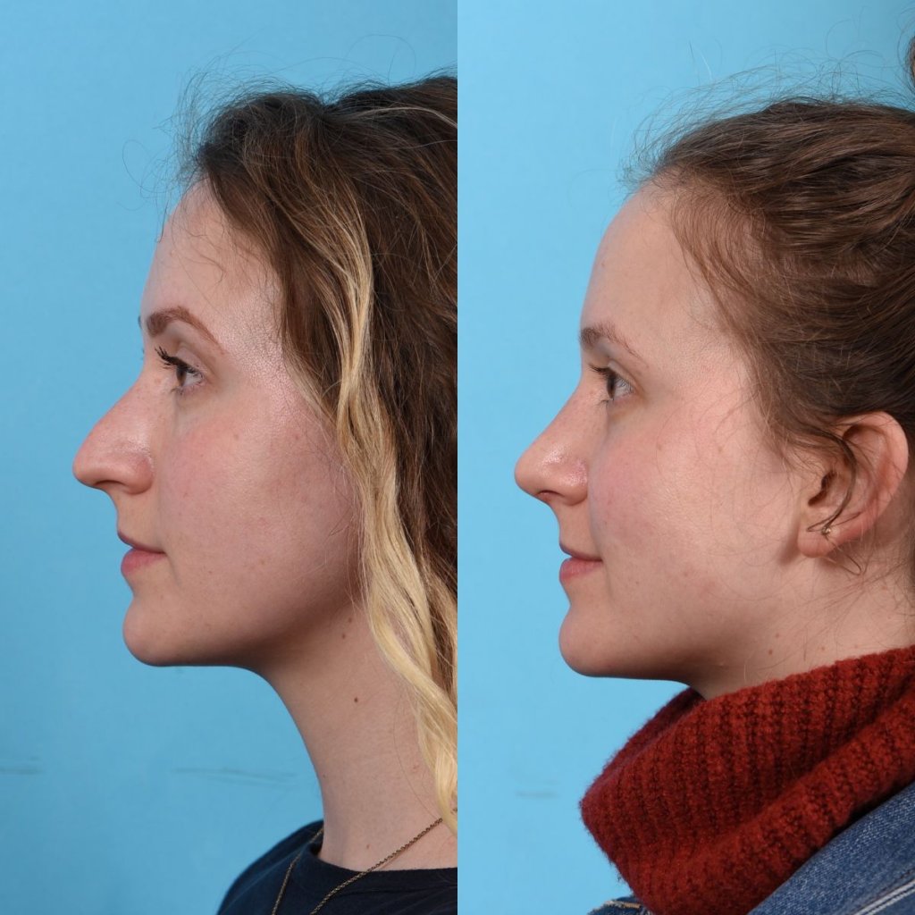 Young female patient Rhinoplasty before and after - leftt side.