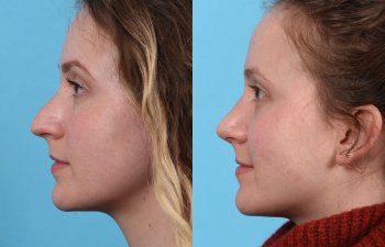 Young female patient Rhinoplasty before and after - leftt side.