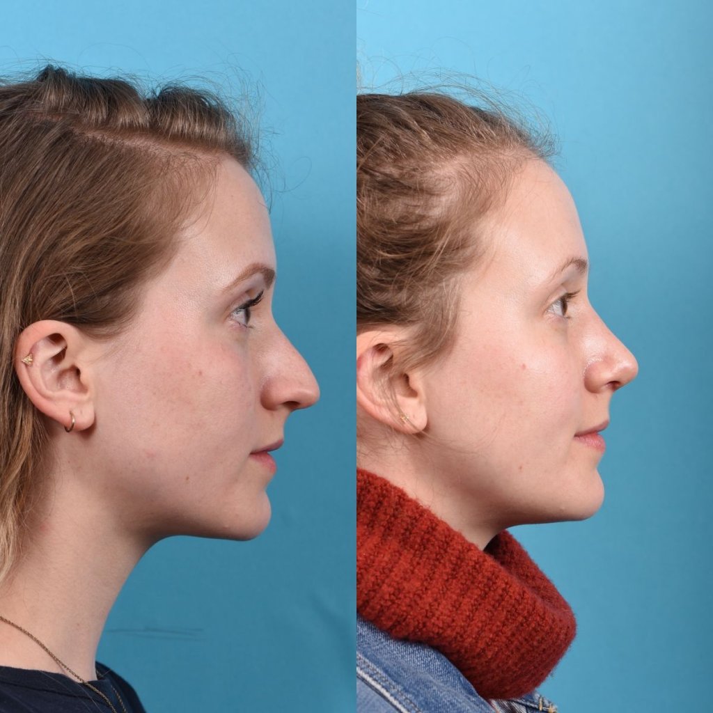 Young female patient Rhinoplasty before and after - right side.