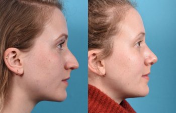 Young female patient Rhinoplasty before and after - right side.