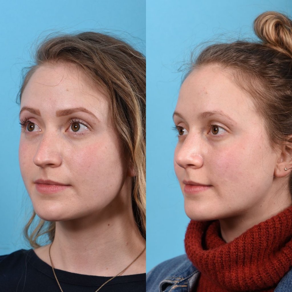 Young female patient Rhinoplasty before and after - leftt side.
