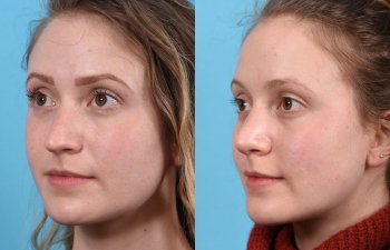 Young female patient Rhinoplasty before and after - leftt side.