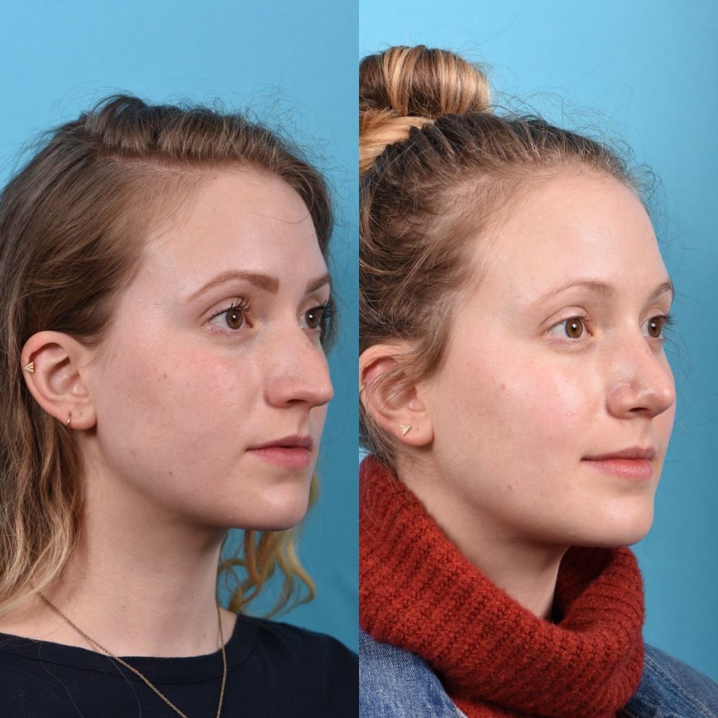 Young female patient Rhinoplasty before and after - right side.