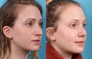 Young female patient Rhinoplasty before and after - right side.