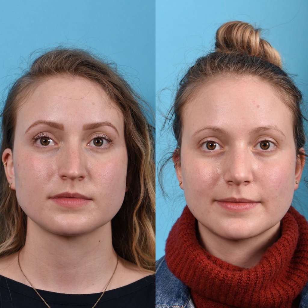 Young female patient Rhinoplasty before and after - front.