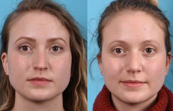 Young female patient Rhinoplasty before and after - front.