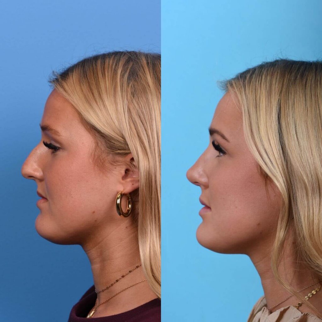 Young female patient Rhinoplasty before and after