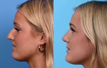 Young female patient Rhinoplasty before and after
