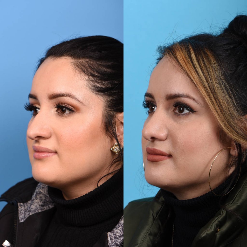 Female patient Rhinoplasty before and after.