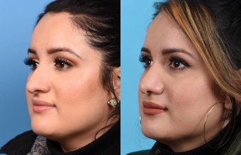 Female patient Rhinoplasty before and after.