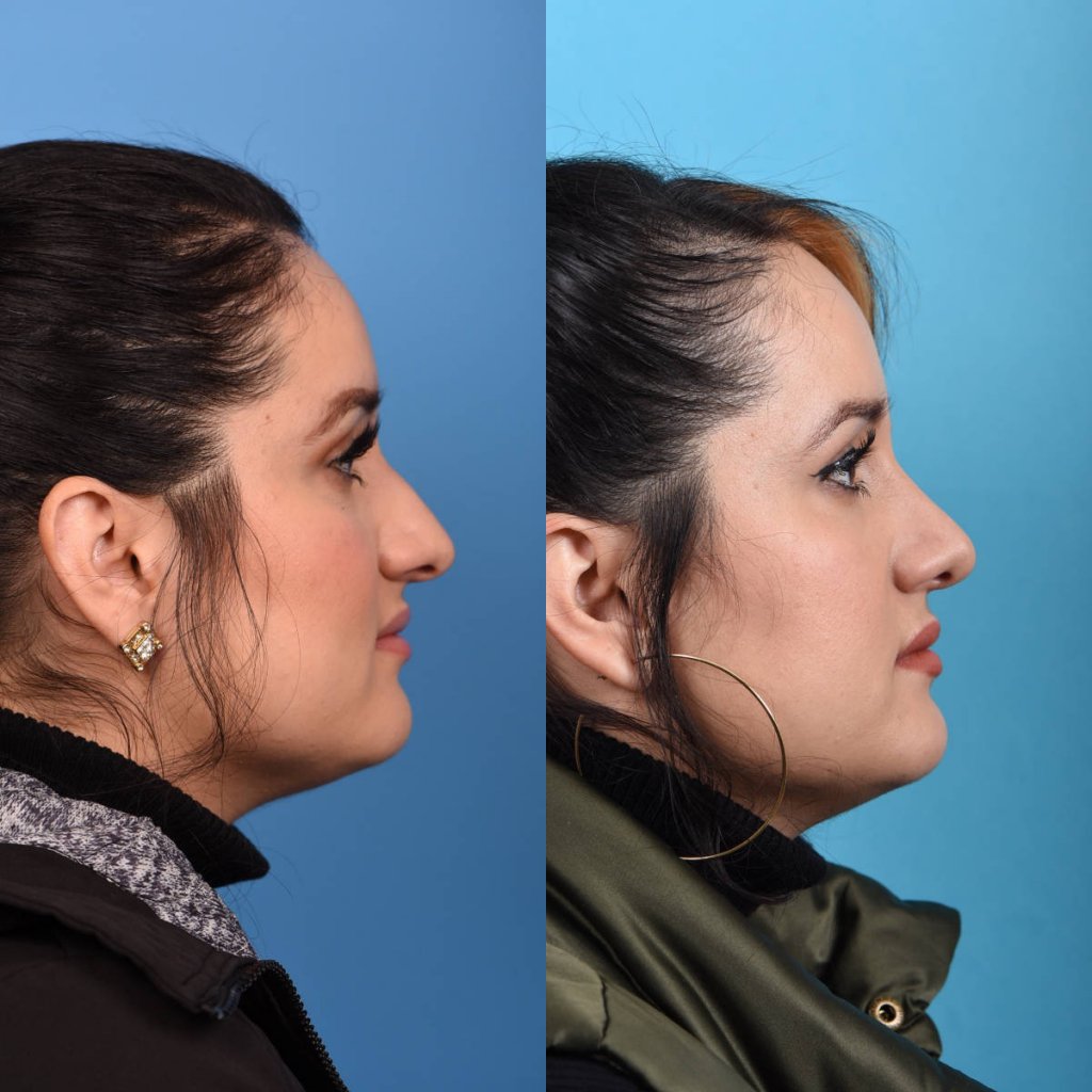 Female patient Rhinoplasty before and after.