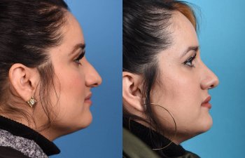Female patient Rhinoplasty before and after.