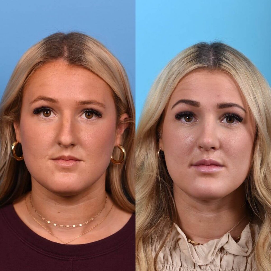 Young female patient Rhinoplasty before and after