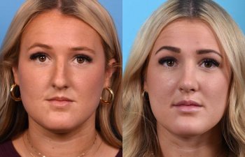 Young female patient Rhinoplasty before and after