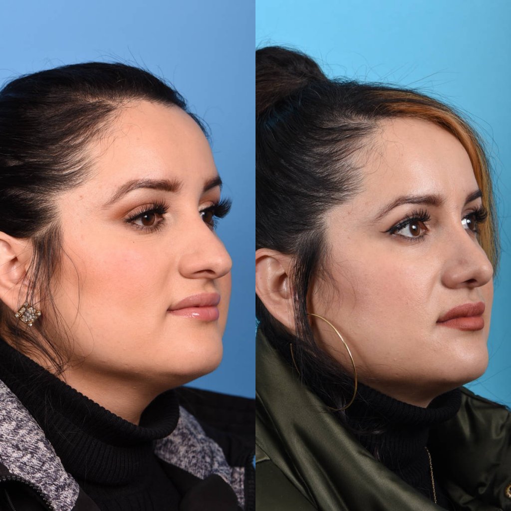 Female patient Rhinoplasty before and after.