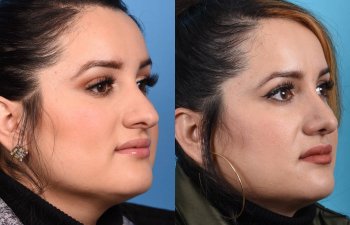 Female patient Rhinoplasty before and after.
