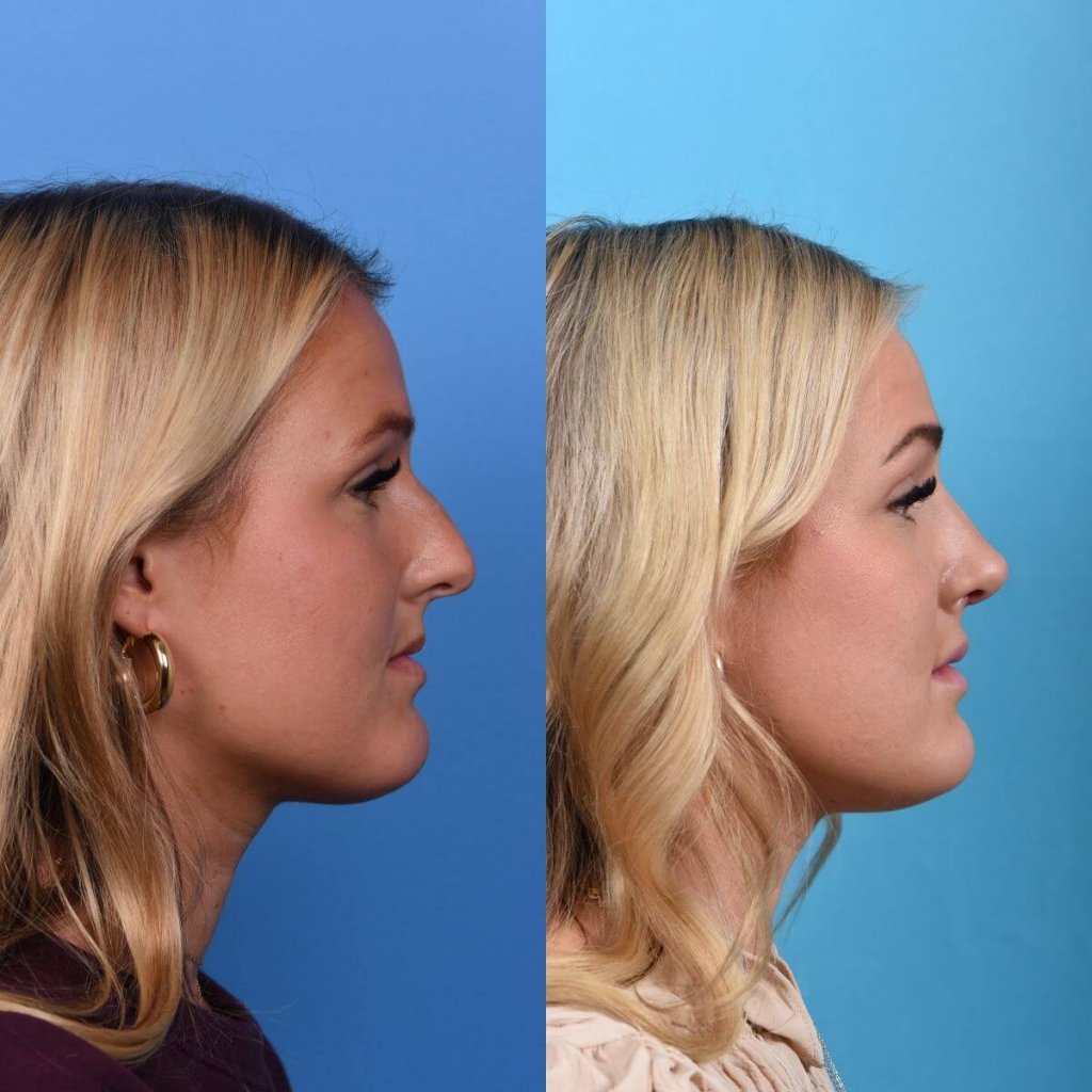 Young female patient Rhinoplasty before and after