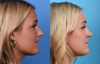 Young female patient Rhinoplasty before and after