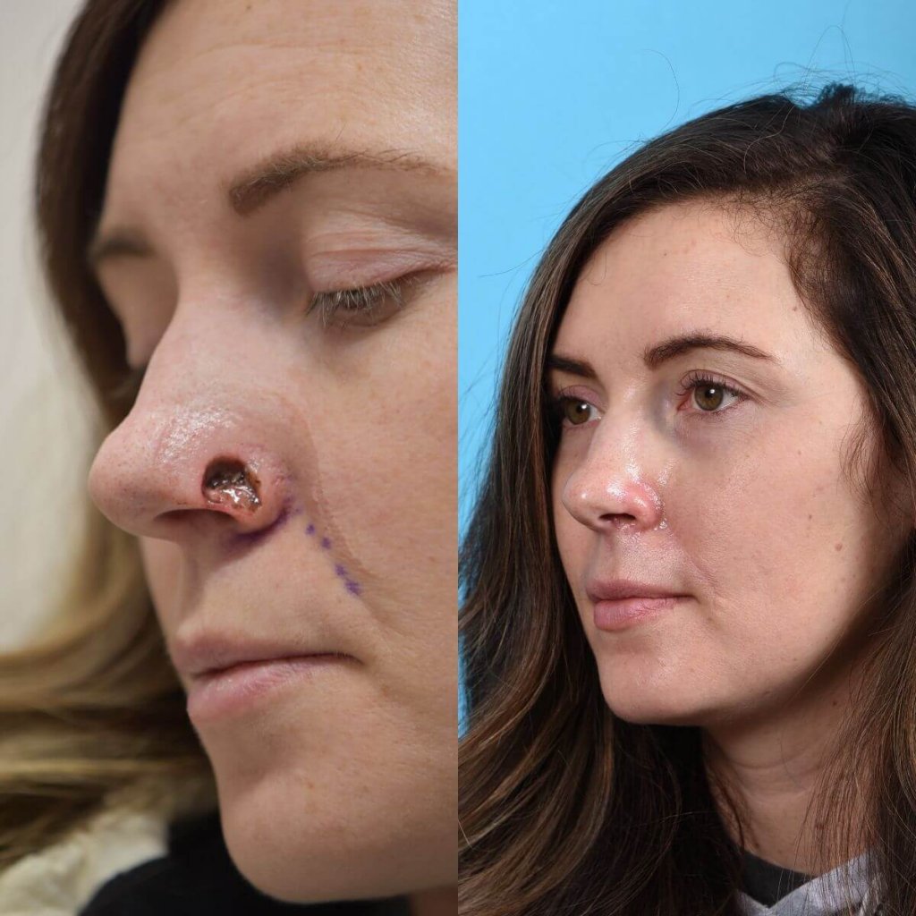 Young woman before and after reconstruction surgery