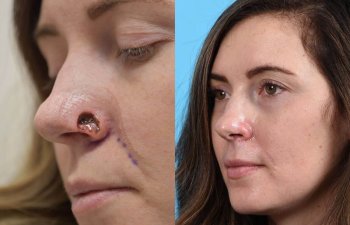 Young woman before and after reconstruction surgery