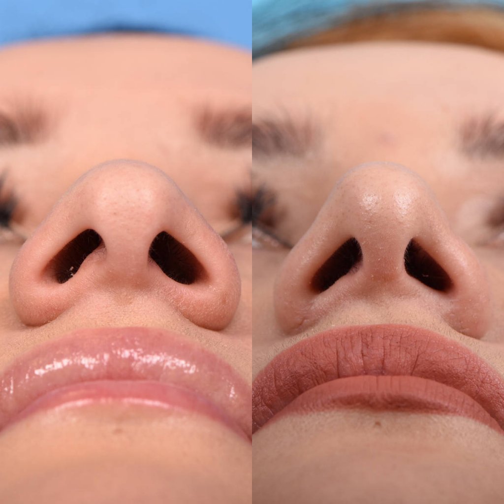 Female patient Rhinoplasty before and after.