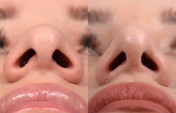 Female patient Rhinoplasty before and after.