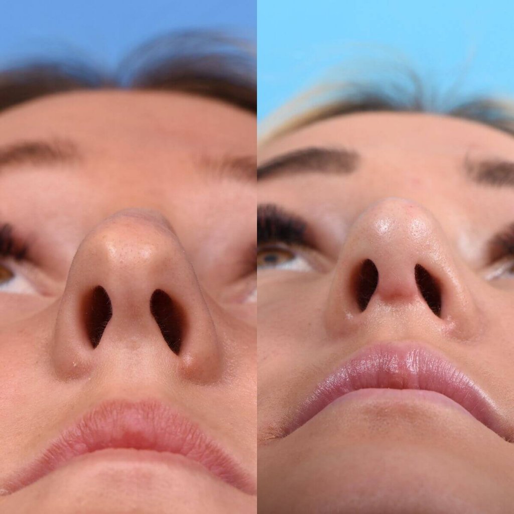 Young female patient Rhinoplasty before and after