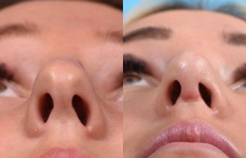 Young female patient Rhinoplasty before and after