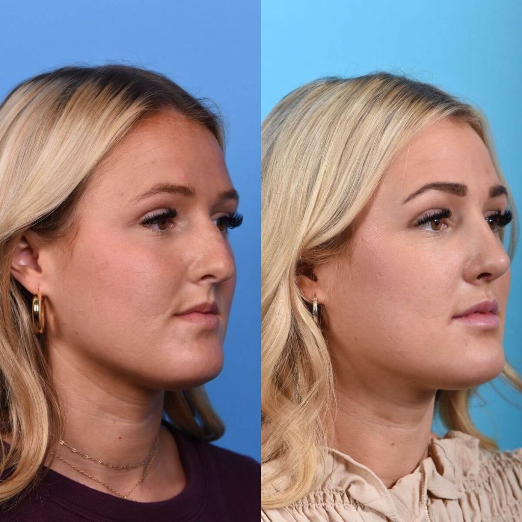 Young female patient Rhinoplasty before and after