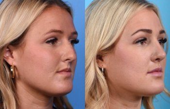 Young female patient Rhinoplasty before and after