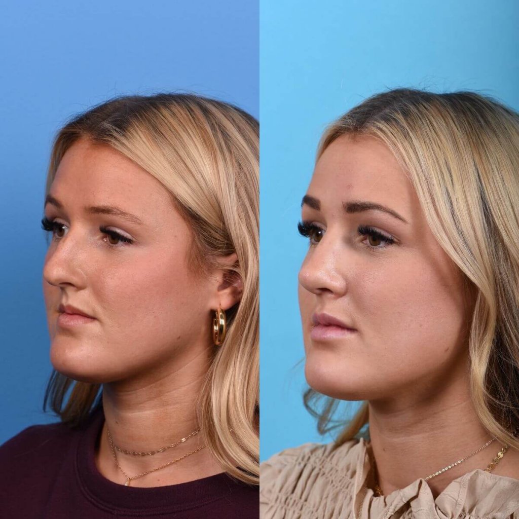 Young female patient Rhinoplasty before and after