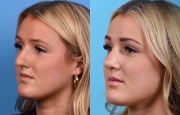 Young female patient Rhinoplasty before and after