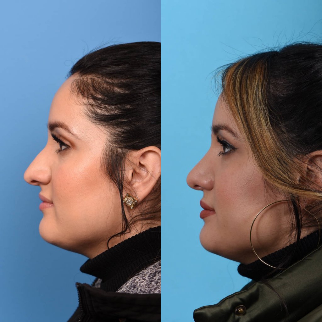 Female patient Rhinoplasty before and after.