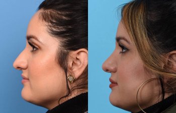 Female patient Rhinoplasty before and after.