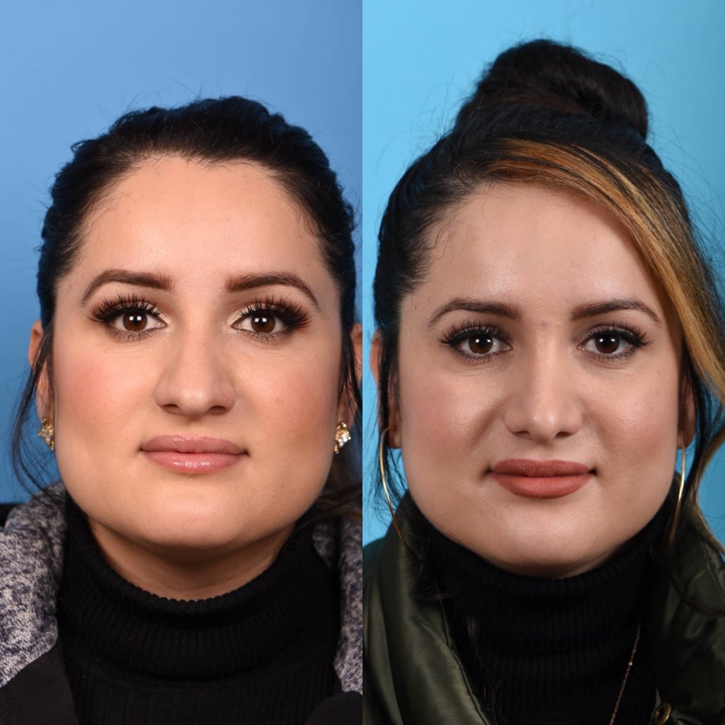 Female patient Rhinoplasty before and after.